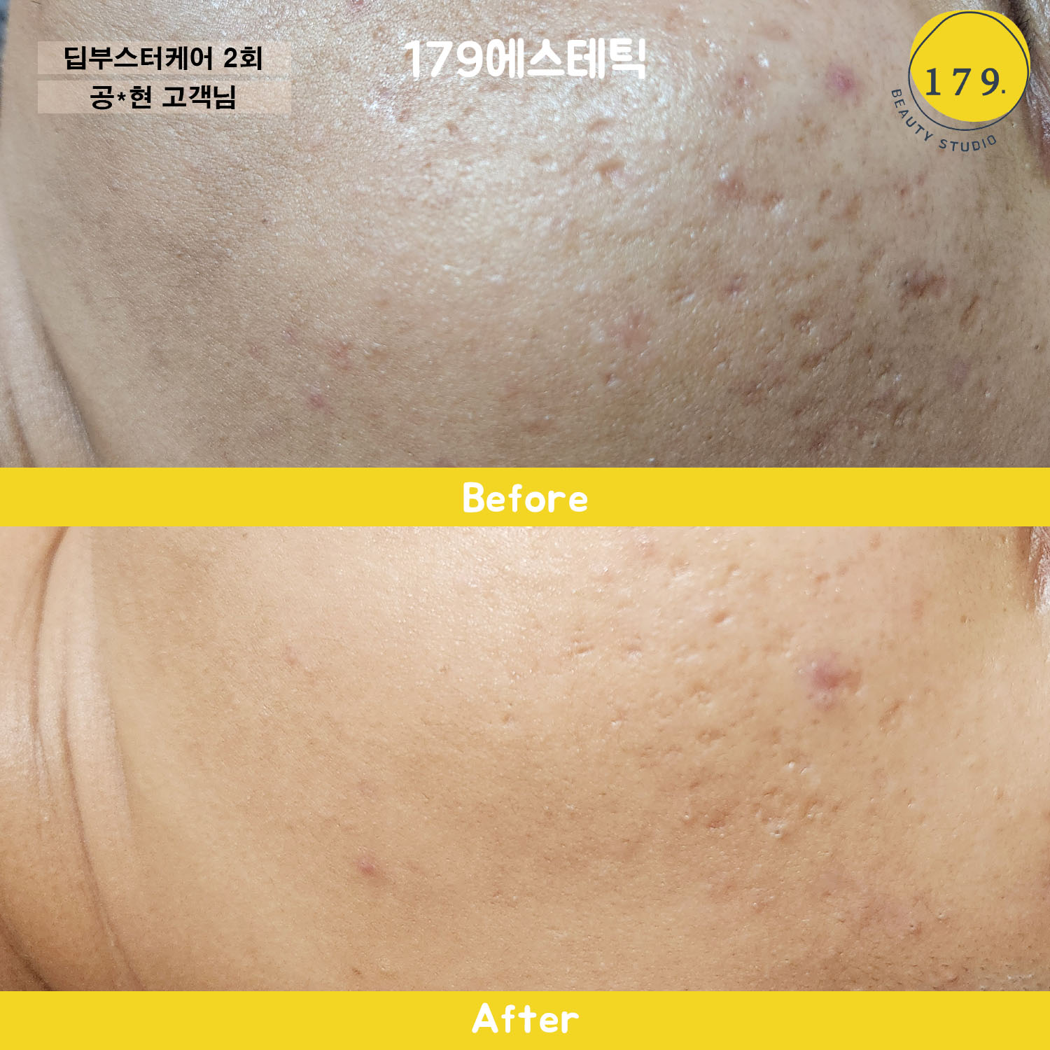 금천구 179에스테틱 30대 남성 여드름 흉터 및 모공 개선 딥부스터 관리 전후 (공*현 고객님) #1