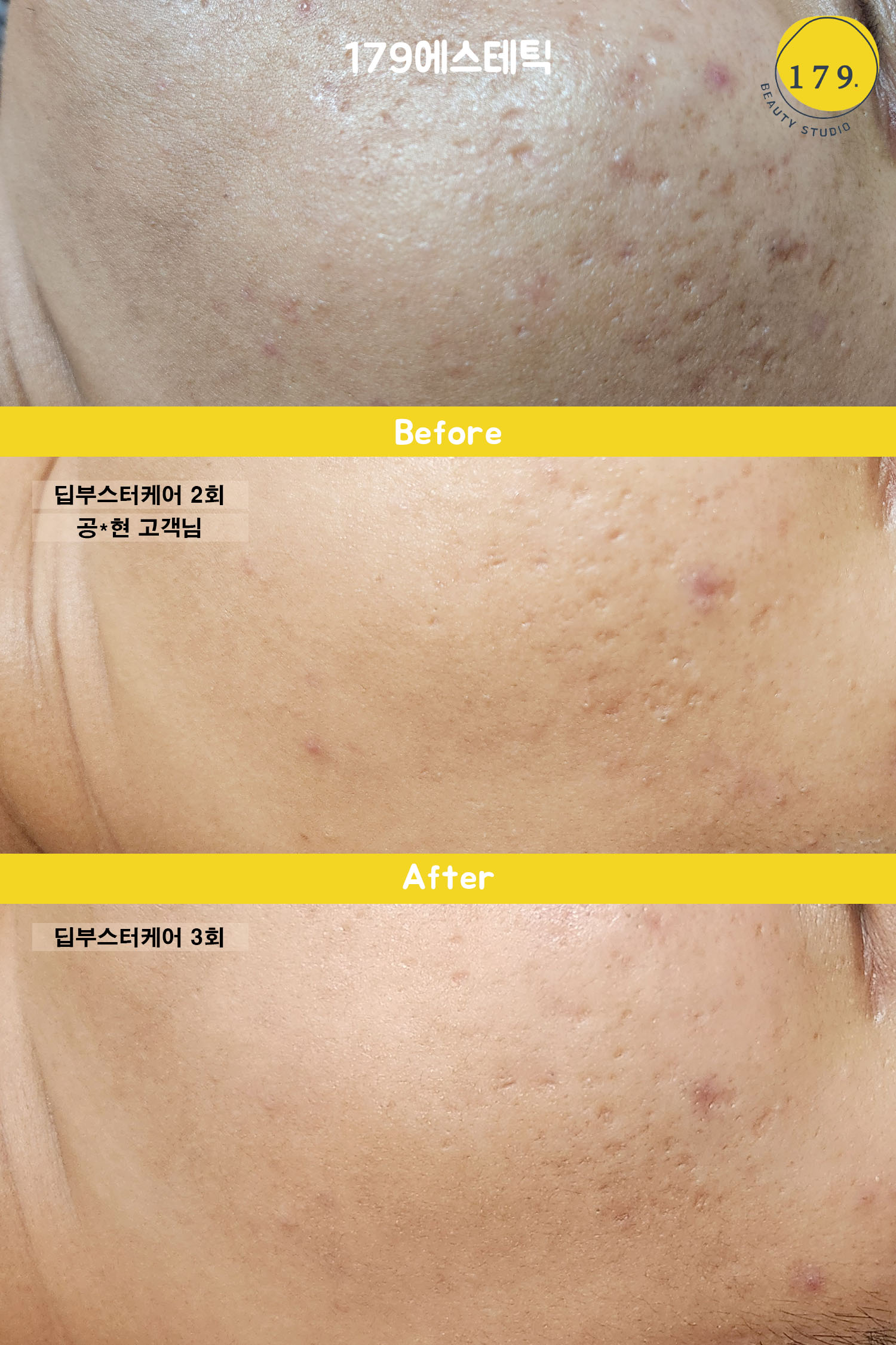 금천구 179에스테틱 30대 남성 딥부스터 3회차 관리 후 흉터 개선 효과 상세 사진