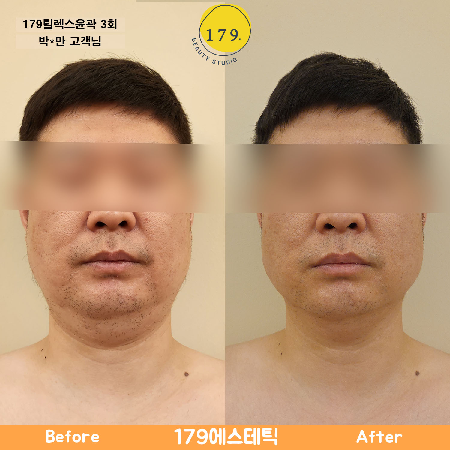 금천구 179에스테틱 40대 남성 이중턱 축소 및 턱선 윤곽 개선 179릴렉스윤곽 3회 관리 전후 (박*만 고객님)