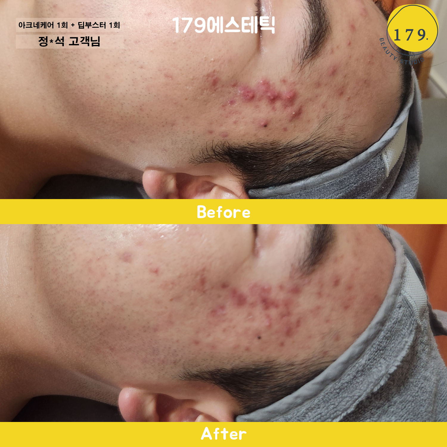 금천구 179에스테틱 20대 남성 볼 화농성 여드름 딥부스터 관리 전후