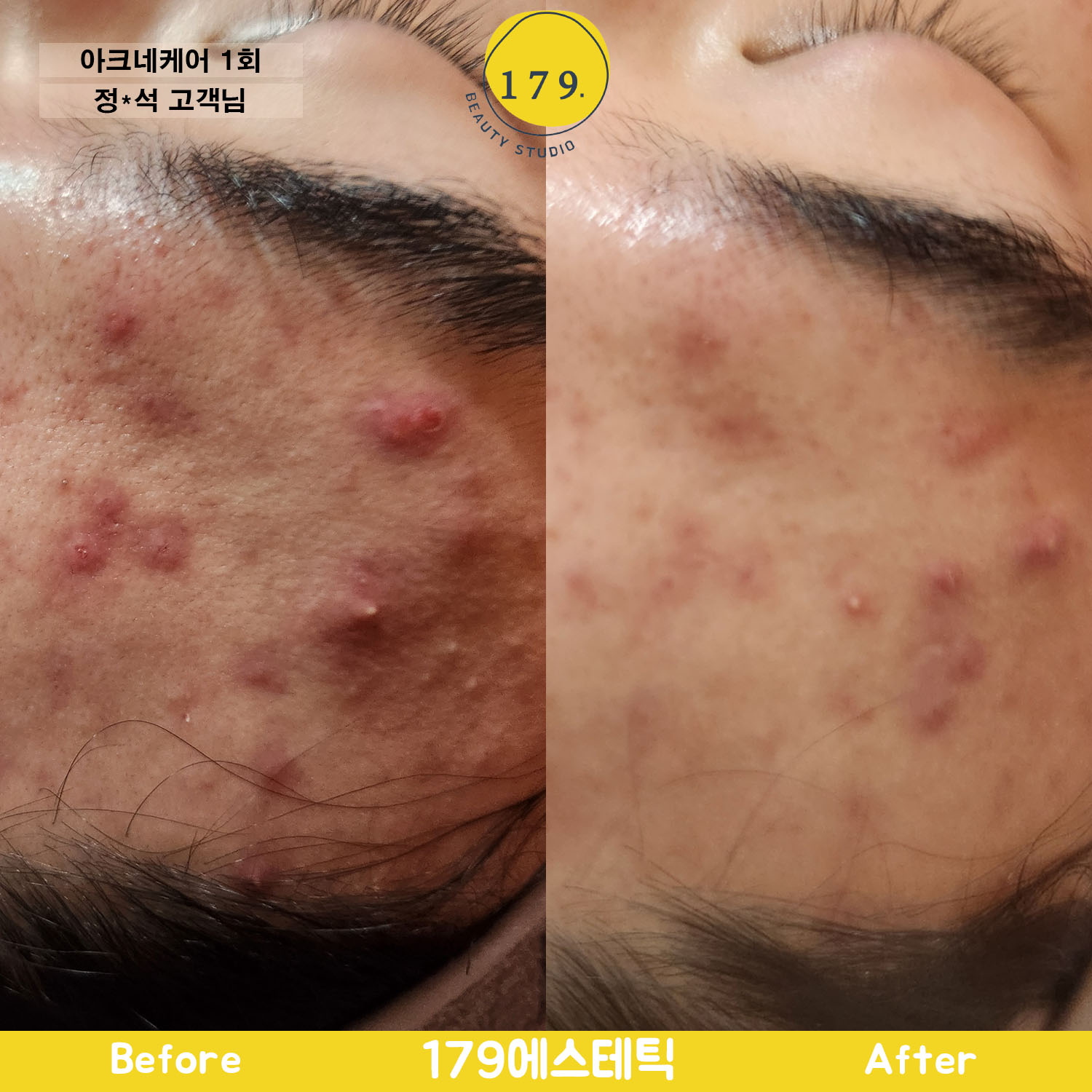 금천구 179에스테틱 20대 남성 심한 화농성 여드름 아크네케어 및 딥부스터 관리 과정 변화 (정*석 고객님) #2