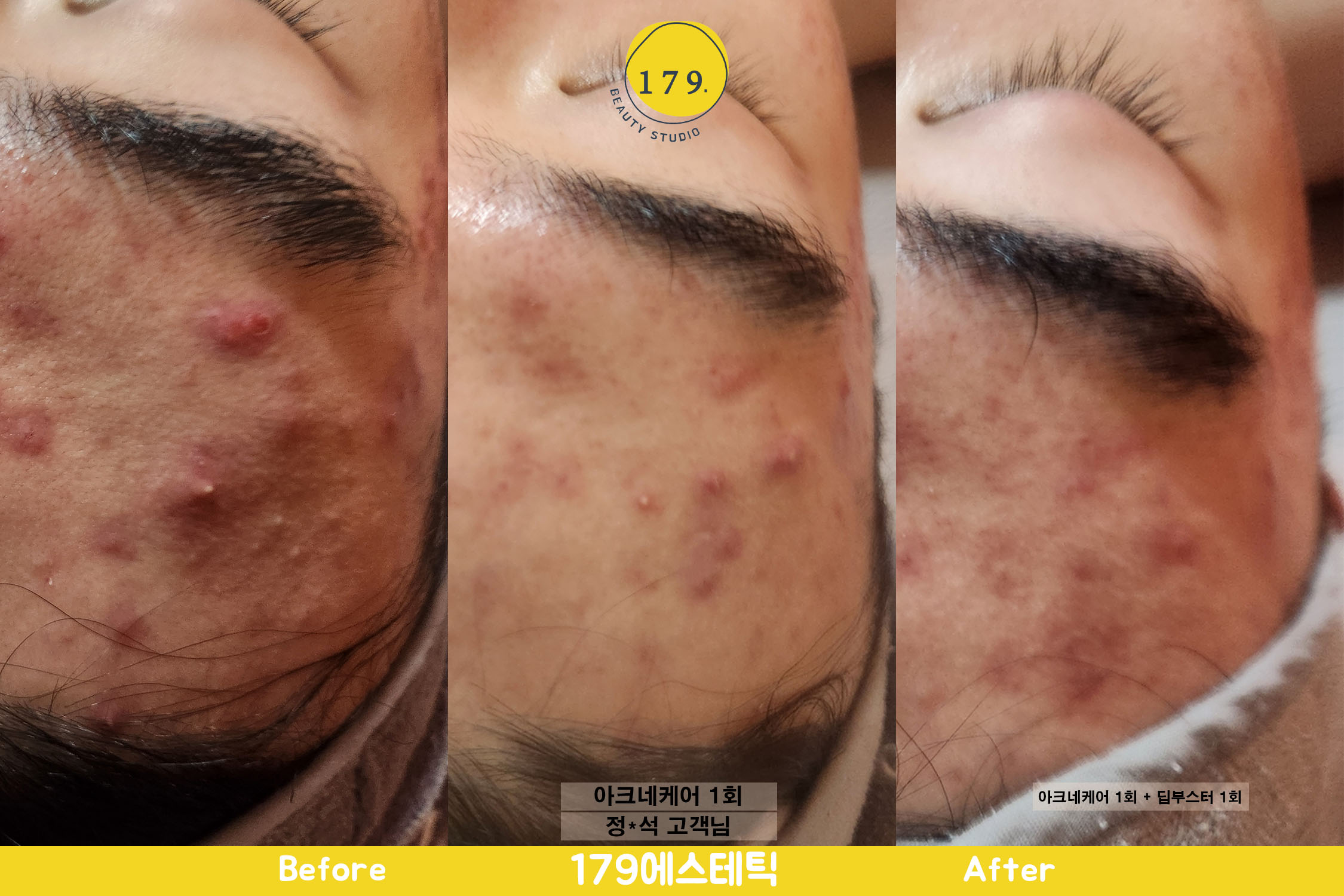 시흥동 에스테틱 남성 염증성 여드름 진정 관리 179에스테틱