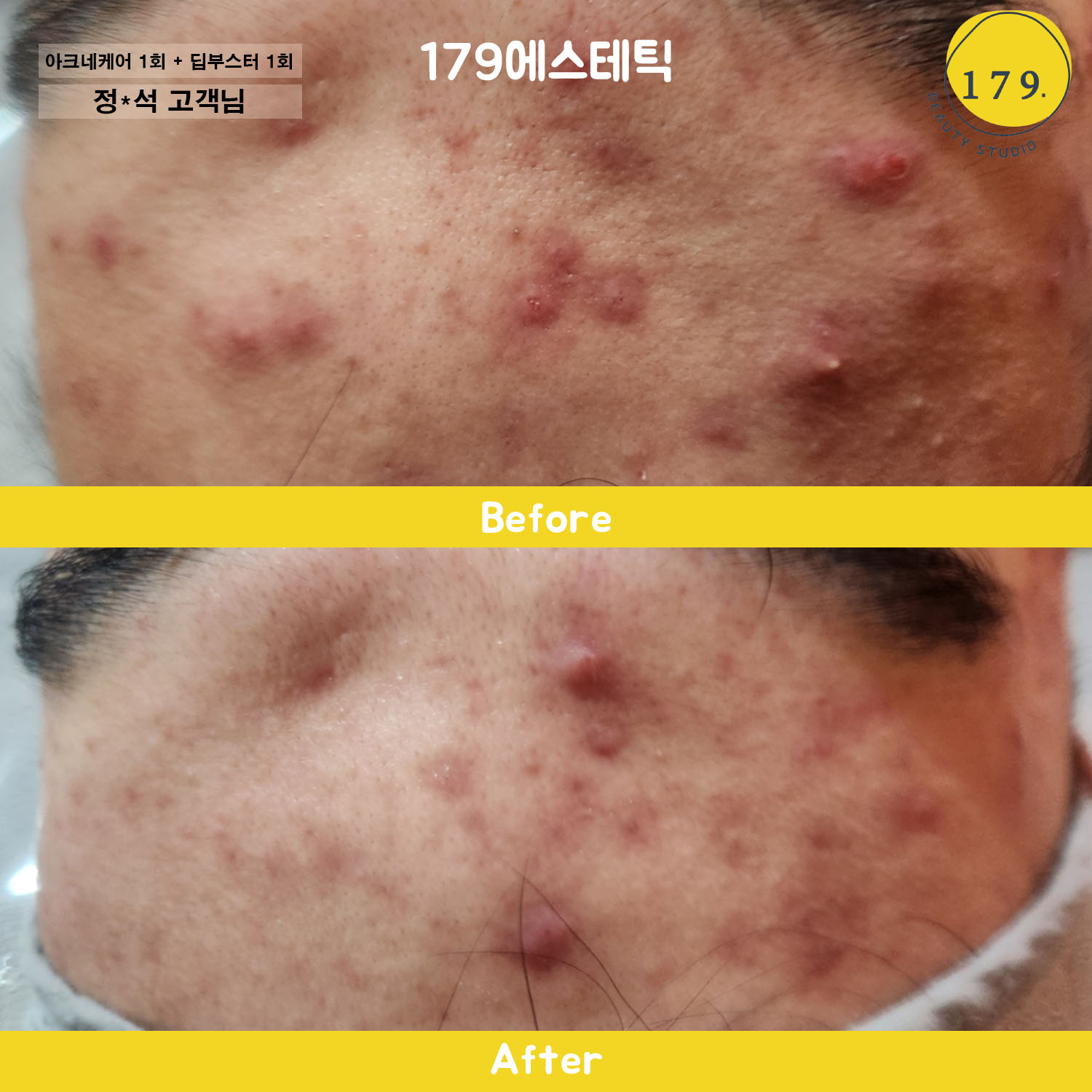 금천구 여드름 붉은기 완화 딥부스터 케어 전후 사진