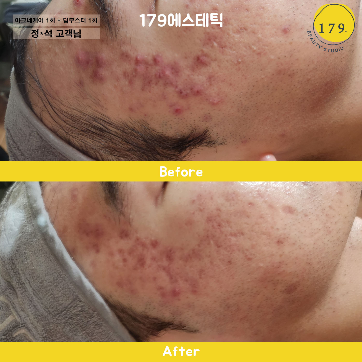 금천구 179에스테틱 문제성 피부 딥부스터 측면 개선 사례