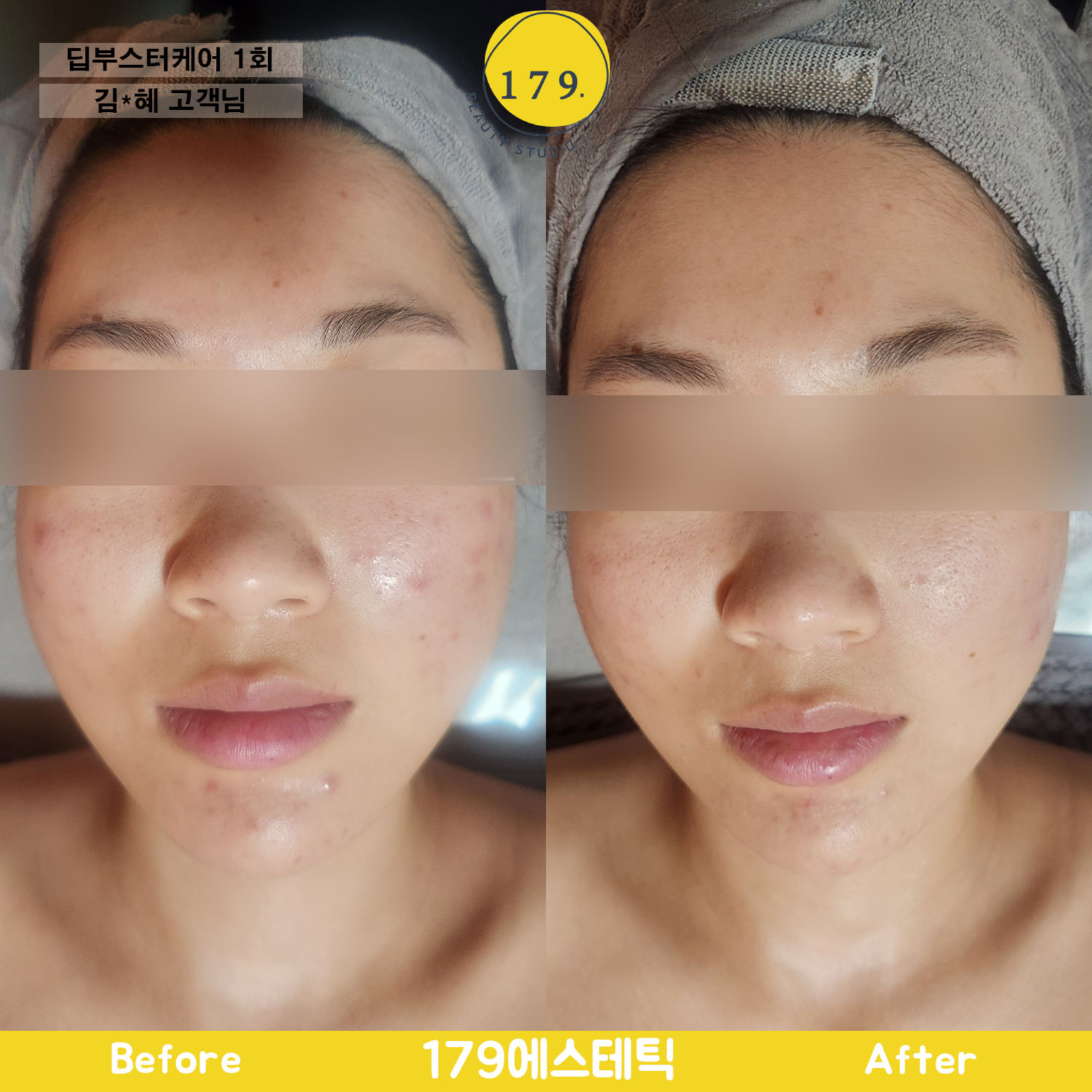 금천구 179에스테틱 30대 여성 여드름 붉은기 딥부스터 관리 전후 1