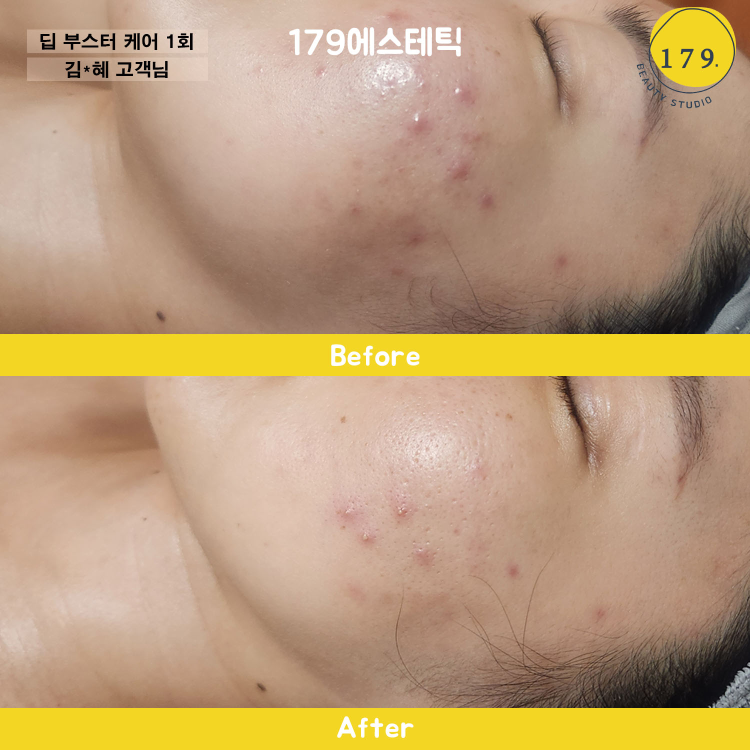 금천구 179에스테틱 30대 여성 화농성 여드름 및 붉은기 진정 딥부스터 관리 1회 전후 (김*혜 고객님) #2