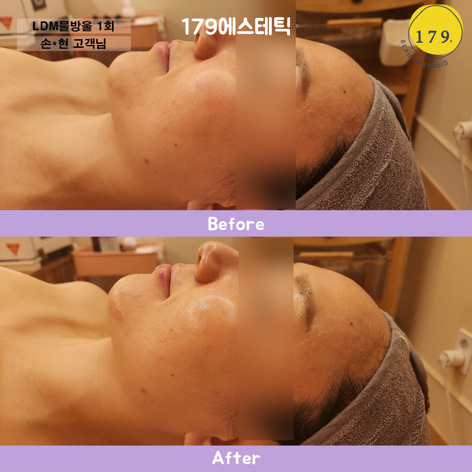 금천구 179에스테틱 30대 여성 속건조 수분 충전 및 피부결 진정 LDM 물방울 초음파 1회 전후 (손*현 고객님)