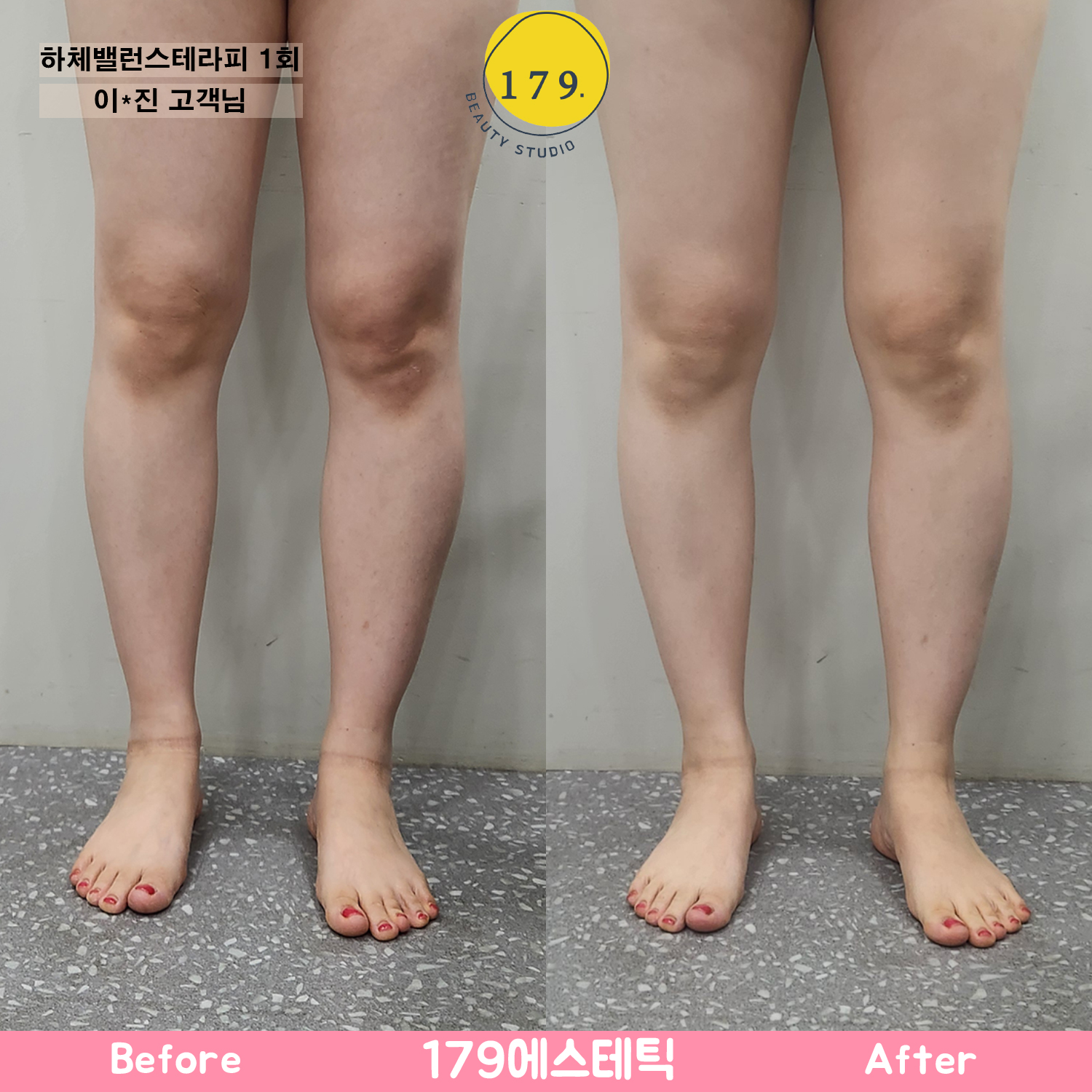 금천구 179에스테틱 30대 여성 하체 부종 및 라인 관리 하체밸런스테라피 1회 전후 (이*진 고객님)