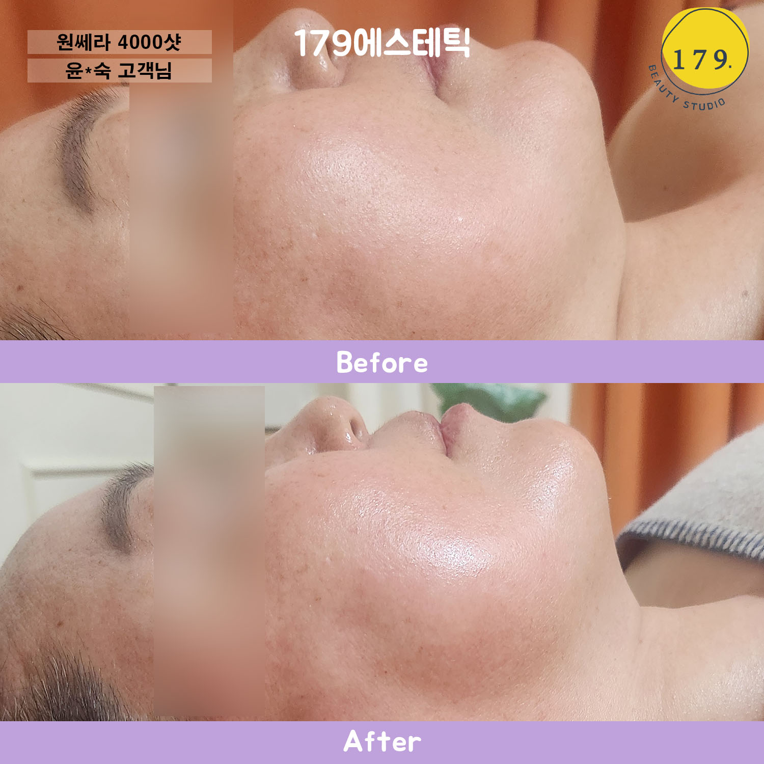 금천구 179에스테틱 50대 여성 턱선 처짐 개선 및 탄력 리프팅 원쎄라 4000샷 관리 전후 (윤*숙 고객님)
