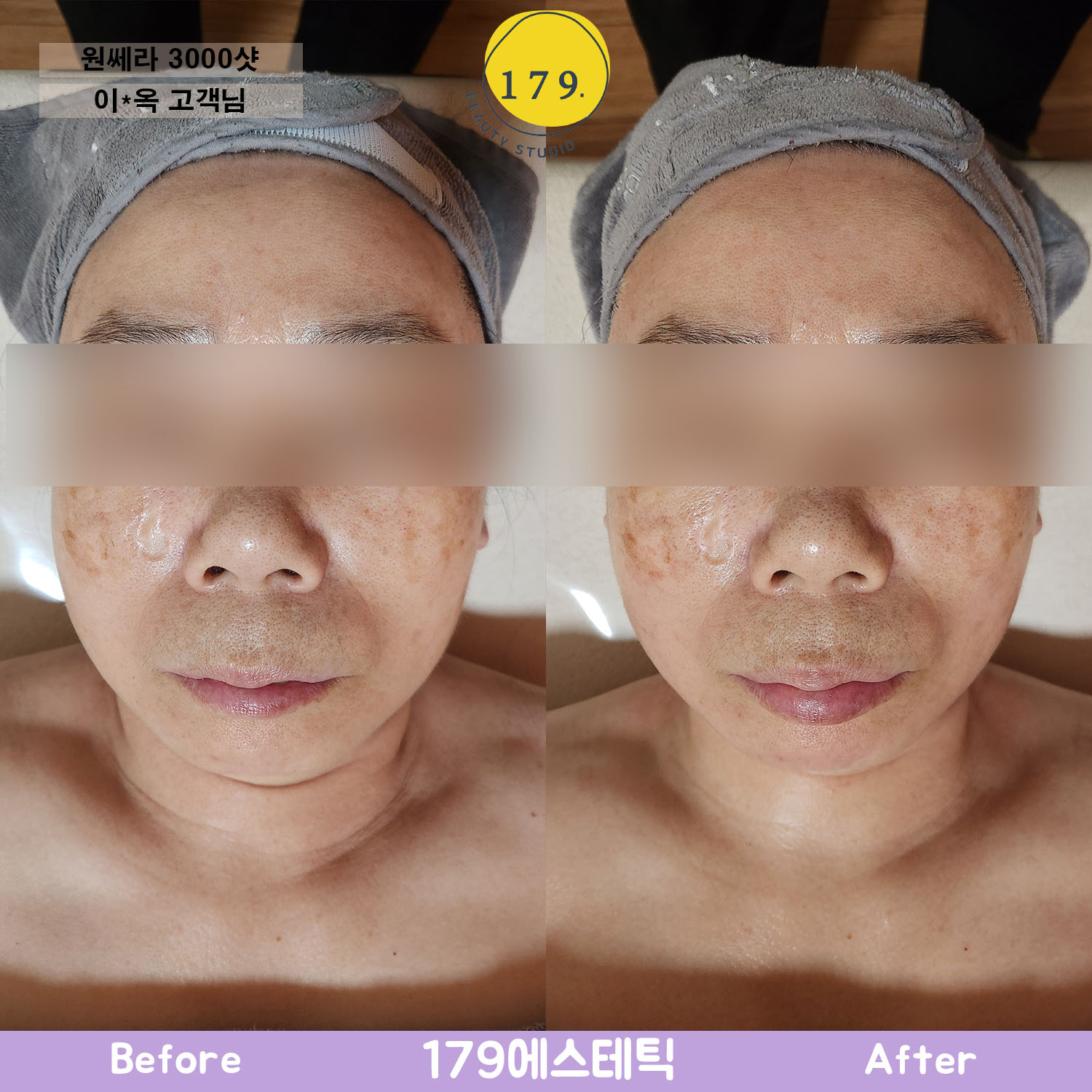 금천구 179에스테틱 50대 여성 피부 처짐 및 탄력 개선 원쎄라 3000샷 리프팅 관리 전후 (이*옥 고객님)