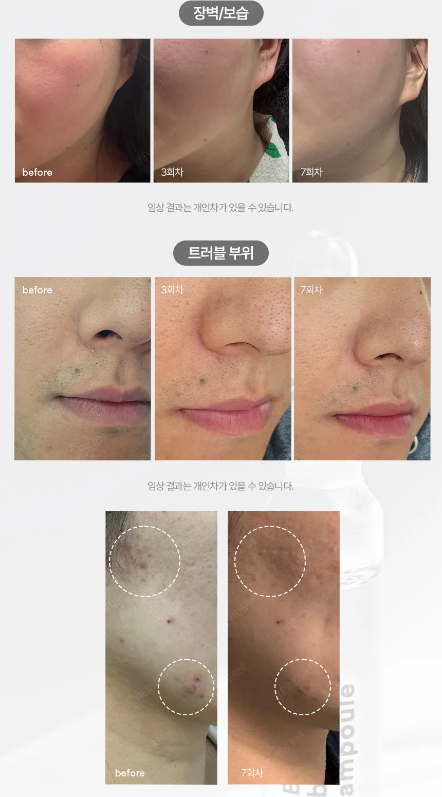 레비덤 B3 브라이트닝 앰플 사용 전후 예시