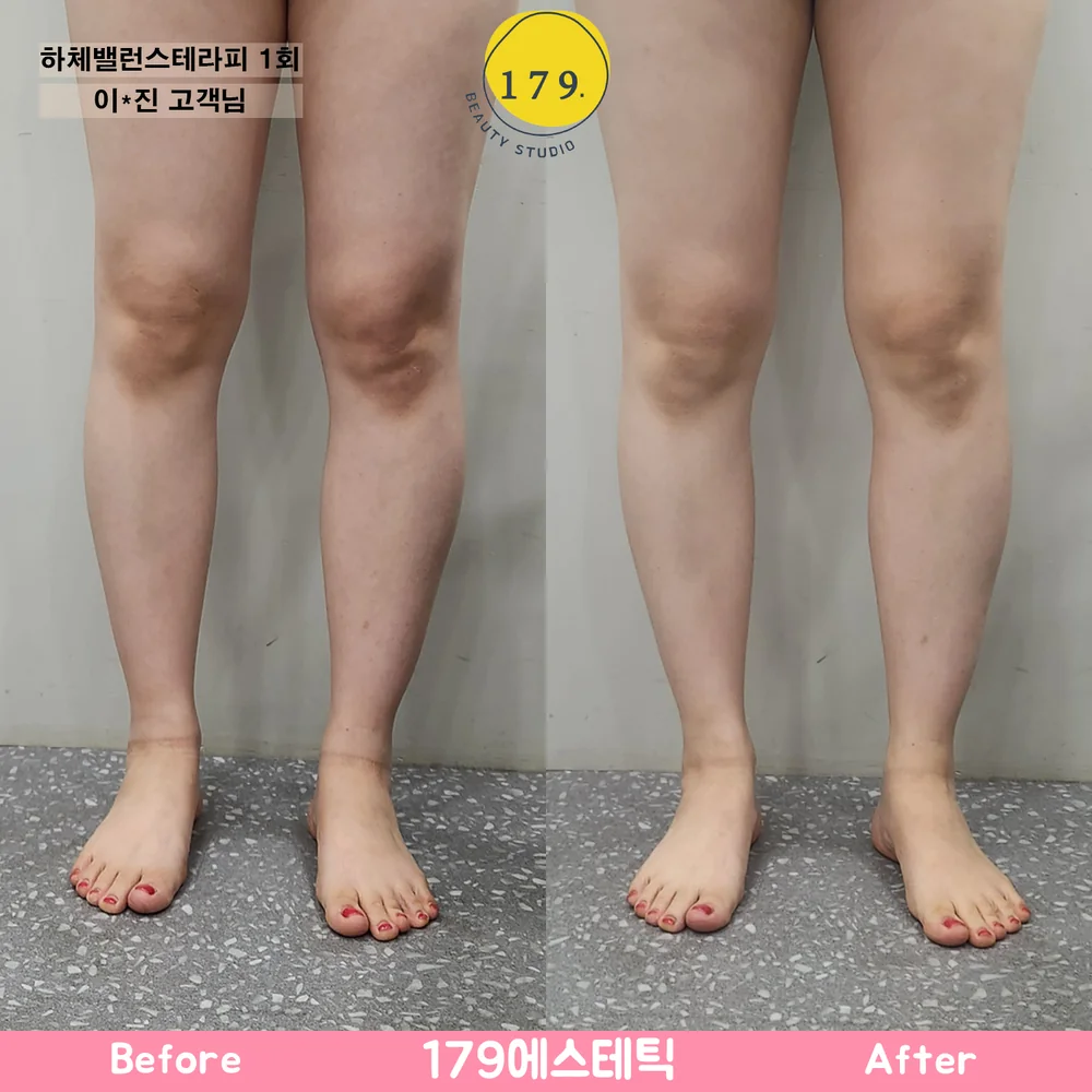 금천구 179에스테틱 30대 여성 하체 부종 및 라인 관리 하체밸런스테라피 1회 전후 (이*진 고객님)